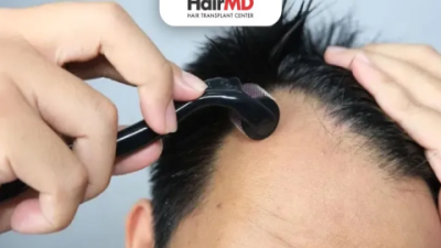 Best Serum to Use with Derma Roller for Hair Growth Tips