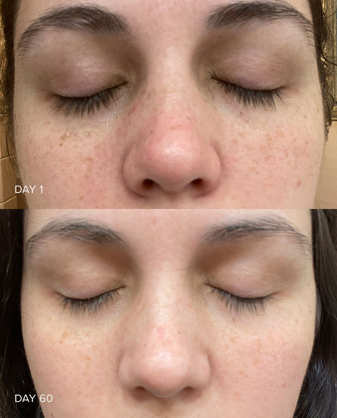 Brightening Vitamin C Serum Before After Dark Spots Gone