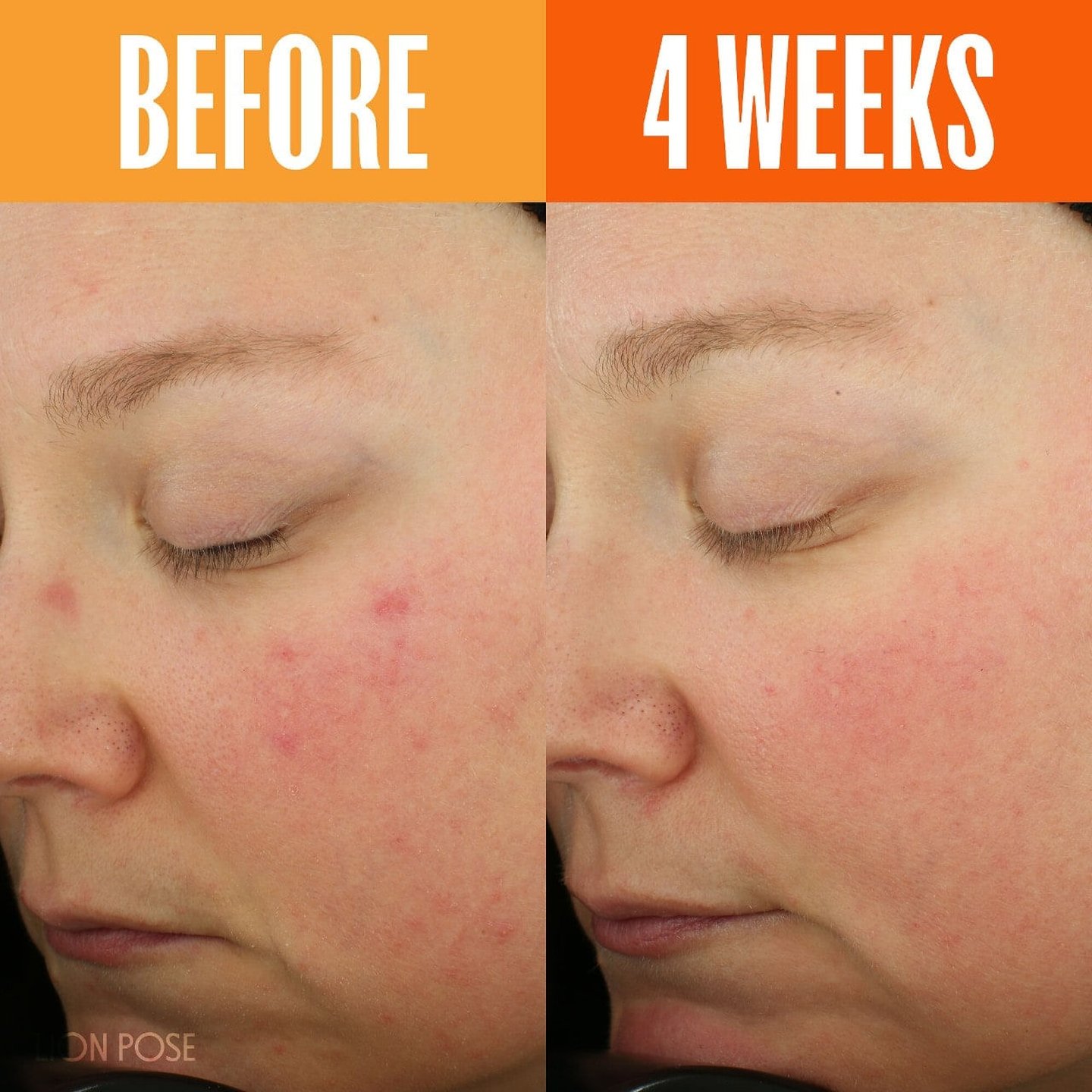Fade Dark Spots Fast with Lion Pose Dark Spot Serum: Your Ultimate Guide to Clearer Skin