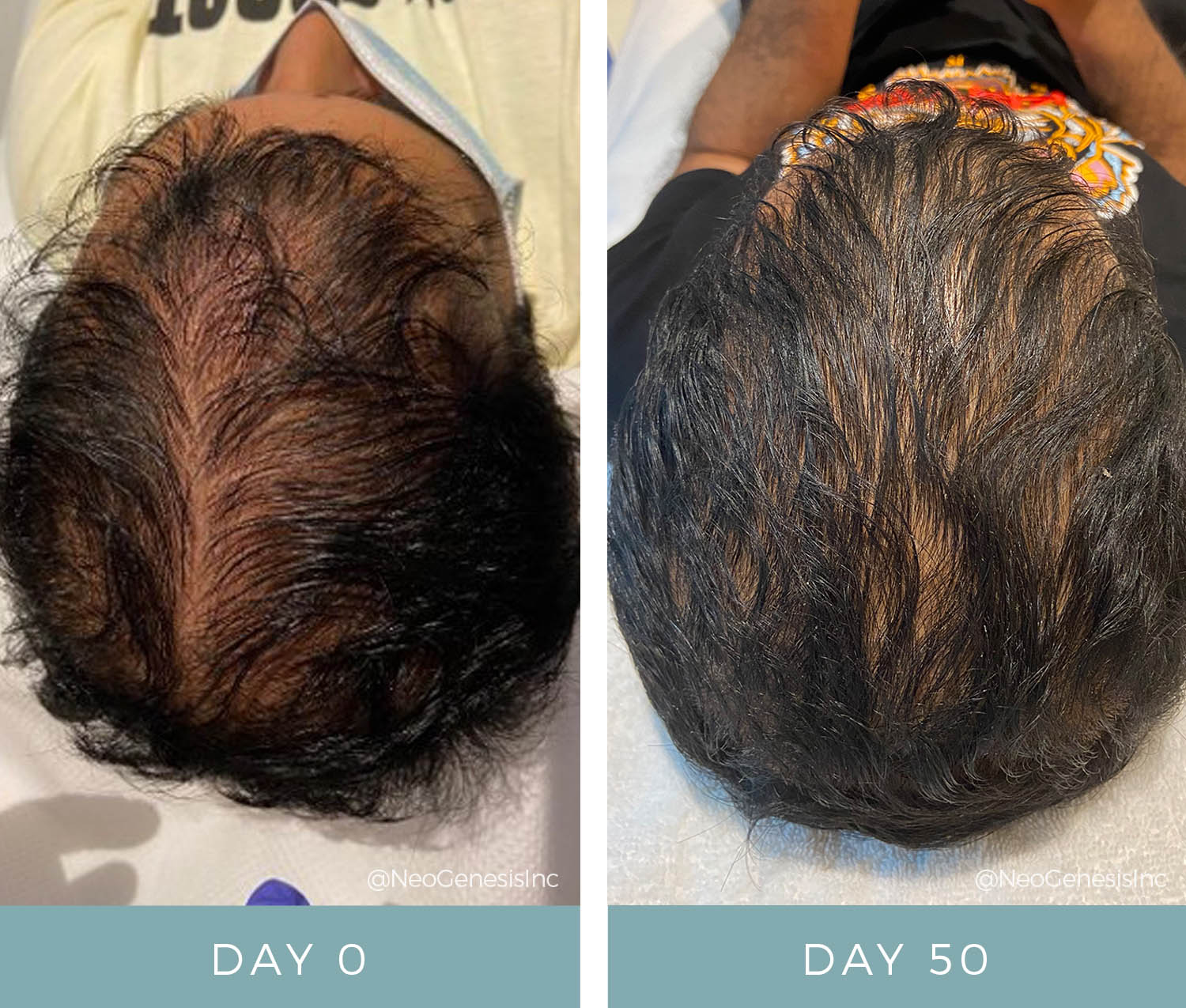 Hair Growth Microneedling Serum That Really Works