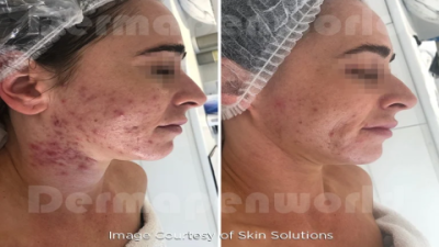 Serum Microneedling: Boost Your Skin’s Glow Today
