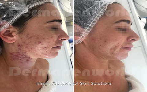 Serum Microneedling: Boost Your Skin’s Glow Today