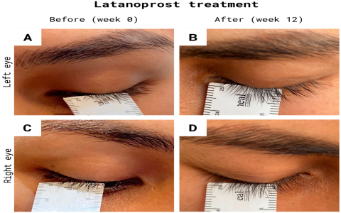 Top-Rated Alpha Lash Serum for Eyelash Growth & Volume Boost