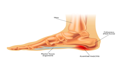 Stiff Feet in Morning? Causes of Heel Pain & Achilles Tendinitis Explained