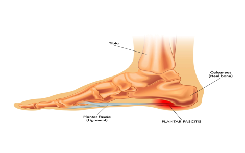 Stiff Feet in Morning? Causes of Heel Pain & Achilles Tendinitis Explained