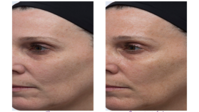 Perricone Eye Serum Results: Your Complete Transformation Timeline