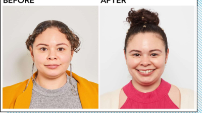 Dark Spots Fade: Vitamin C Serum Before and After Glow
