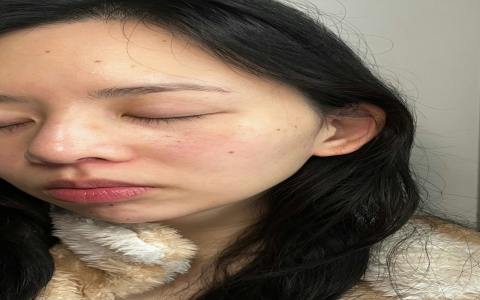 Viral Ilso Super Melting Serum Softener Melts Blackheads