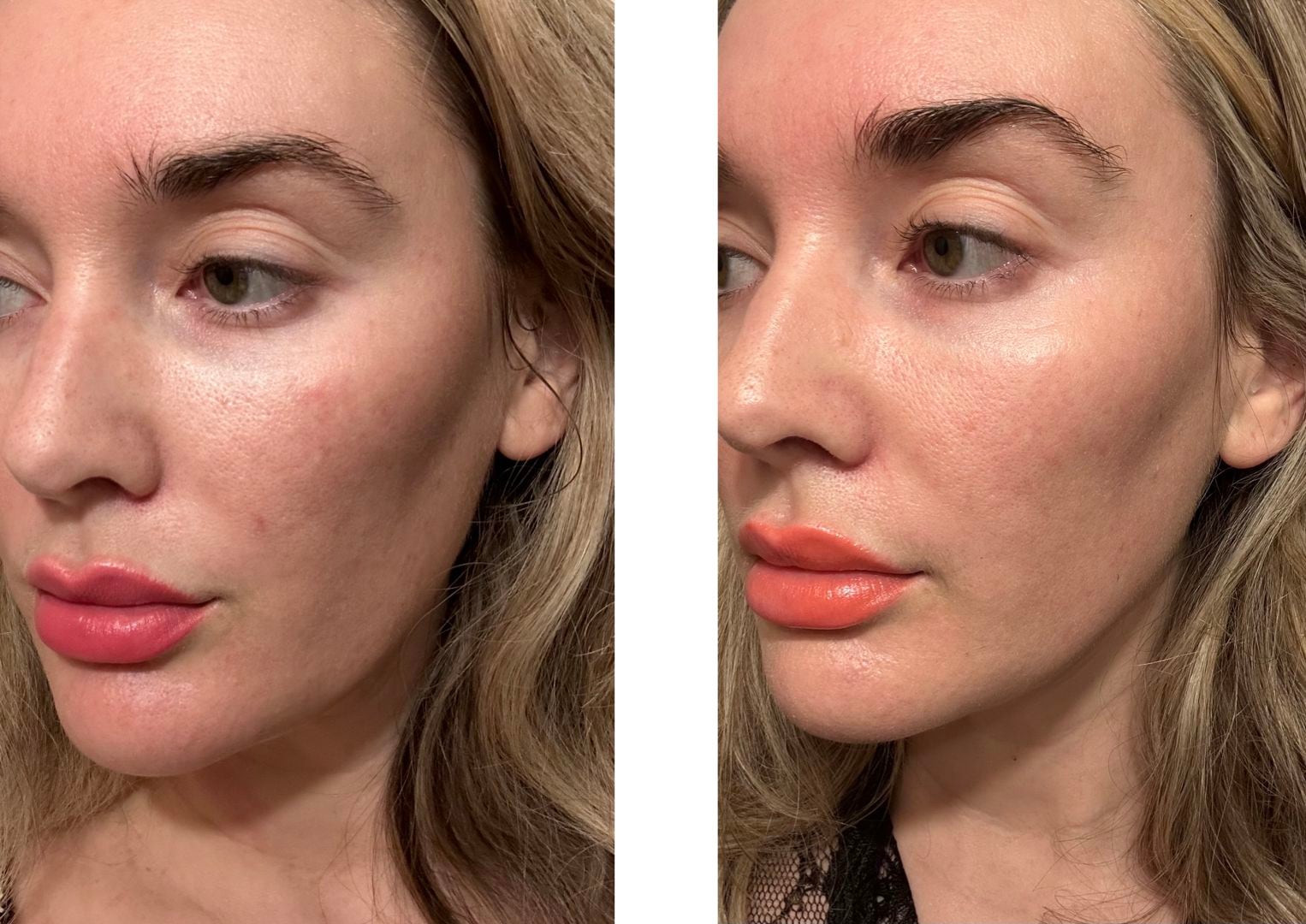 Plated Intense Serum: 6-Week Wrinkle Transformation