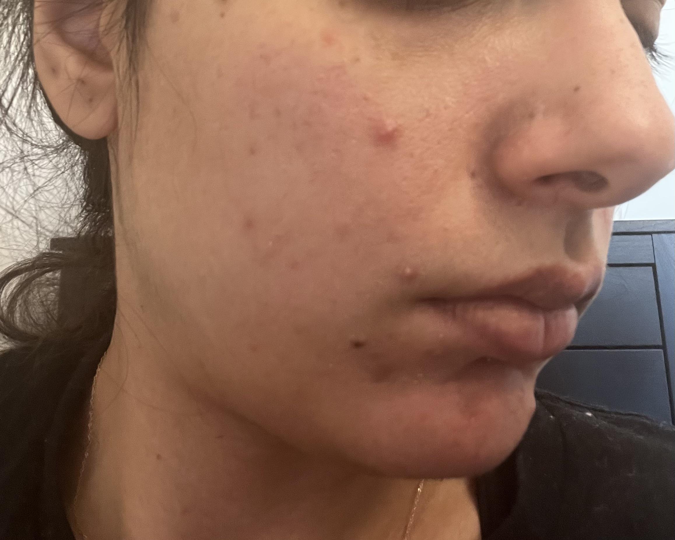 Will Vitamin C Serum Cause Breakouts? Truth Revealed!
