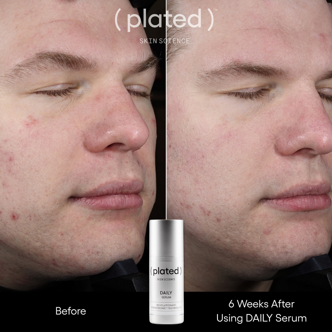 Plated Intense Serum: 6-Week Wrinkle Transformation