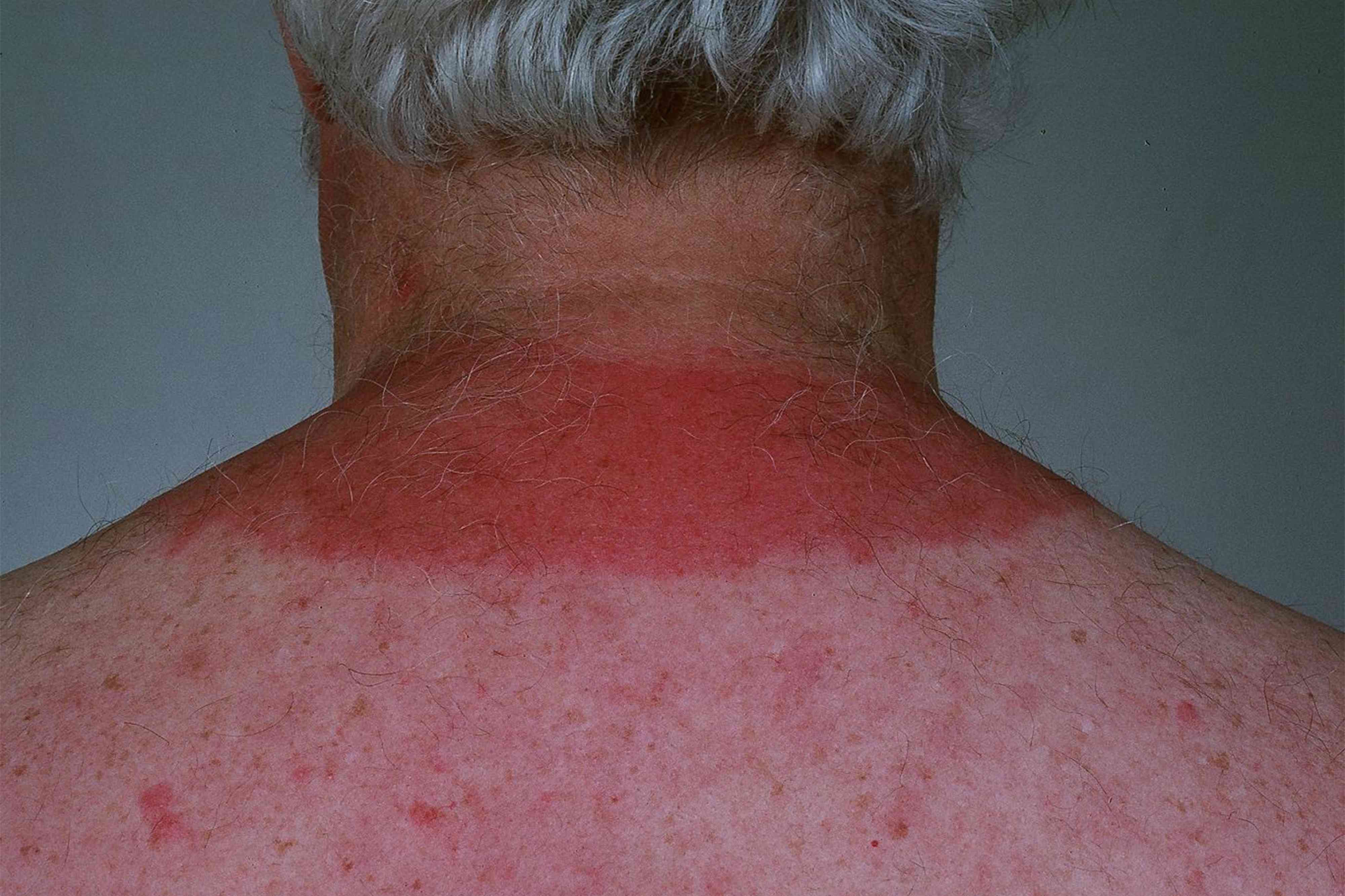 Life Jacket Rash? Ouch! What to Do About That Pesky Skin Irritation