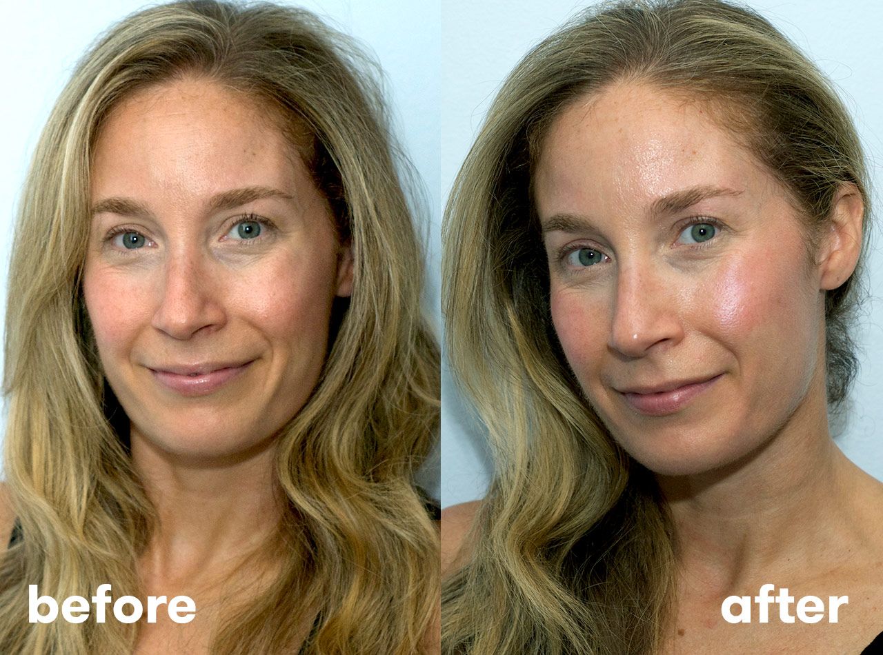 Hyaluronic Acid Serum Before After Results You Need to See