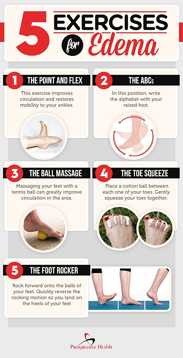 Foot Edema Exercises to Reduce Swollen Ankles and Improve Circulation