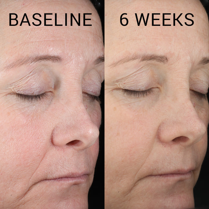 Hyaluronic Acid Serum Before After Results You Need to See
