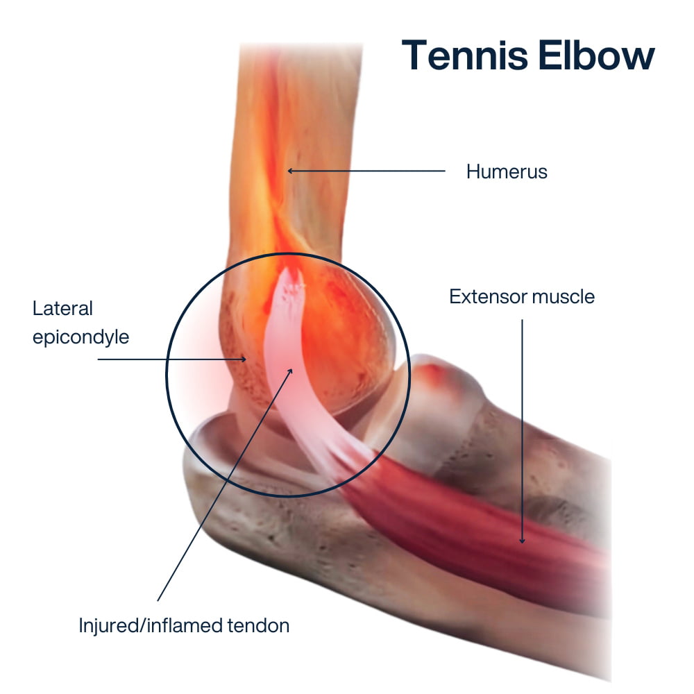 Why You Can't Straighten Arms: Causes & Elbow Pain Relief Tips