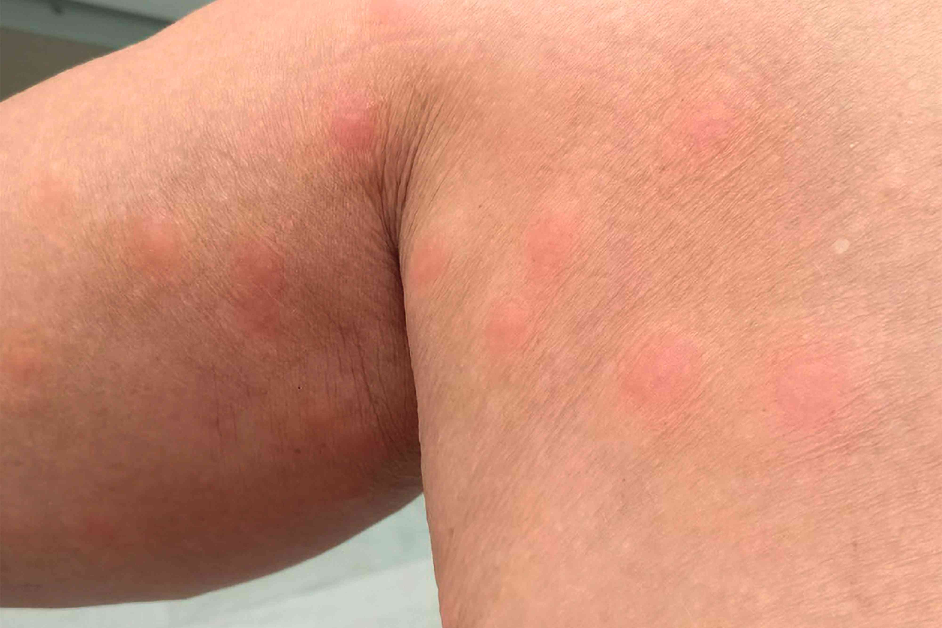 Life Jacket Rash? Ouch! What to Do About That Pesky Skin Irritation