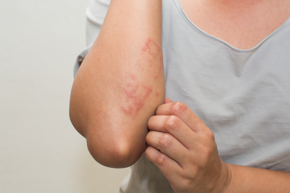 Life Jacket Rash? Ouch! What to Do About That Pesky Skin Irritation
