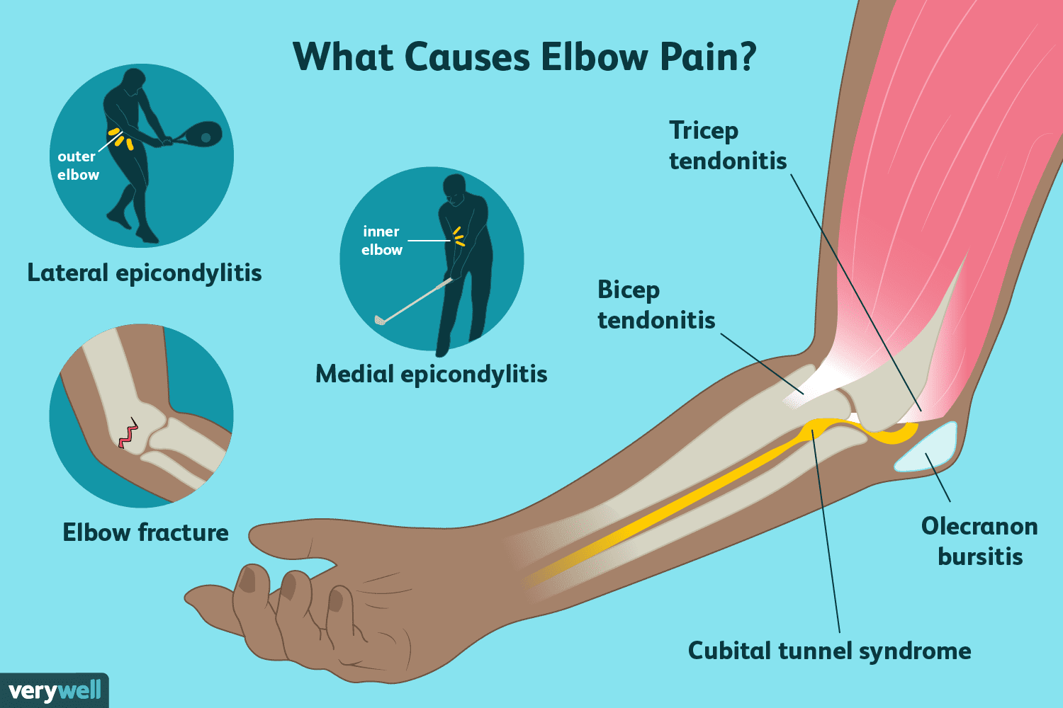 Why You Can't Straighten Arms: Causes & Elbow Pain Relief Tips