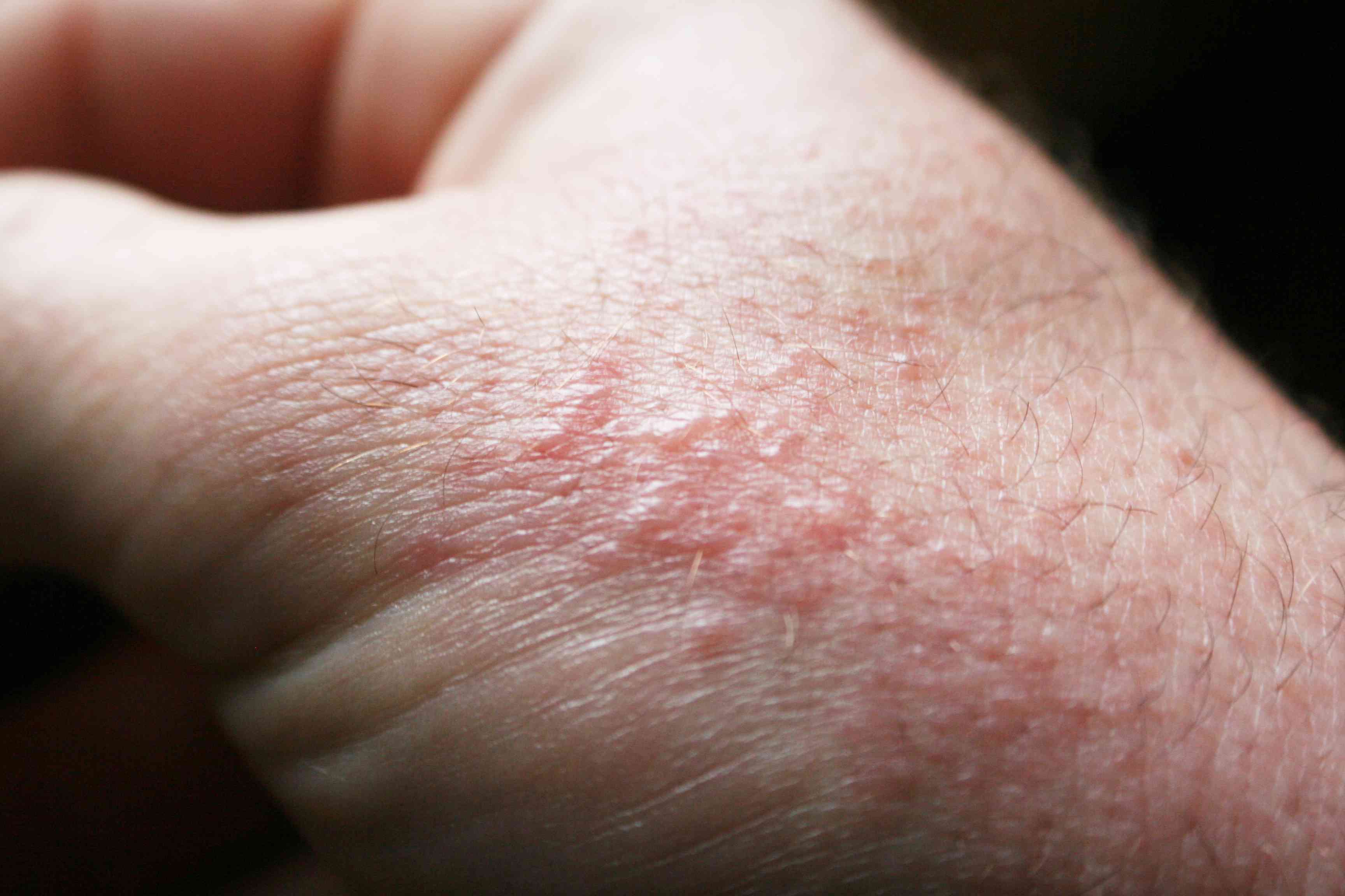 Life Jacket Rash? Ouch! What to Do About That Pesky Skin Irritation