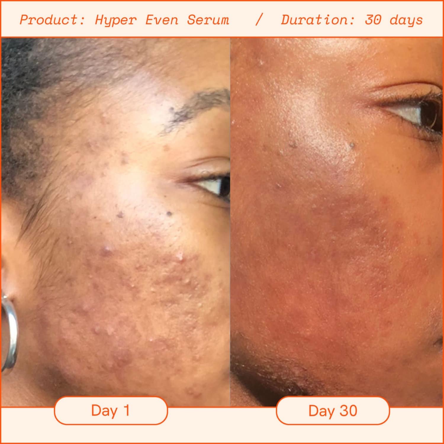 Brightening Vitamin C Serum Before After Dark Spots Gone