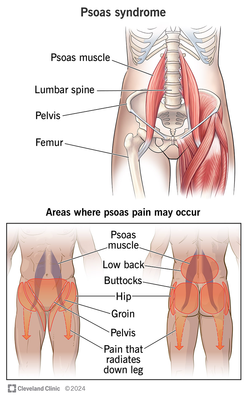 Psoas Muscle Rupture Recovery: Symptoms and Treatment Options for Hip Pain Relief