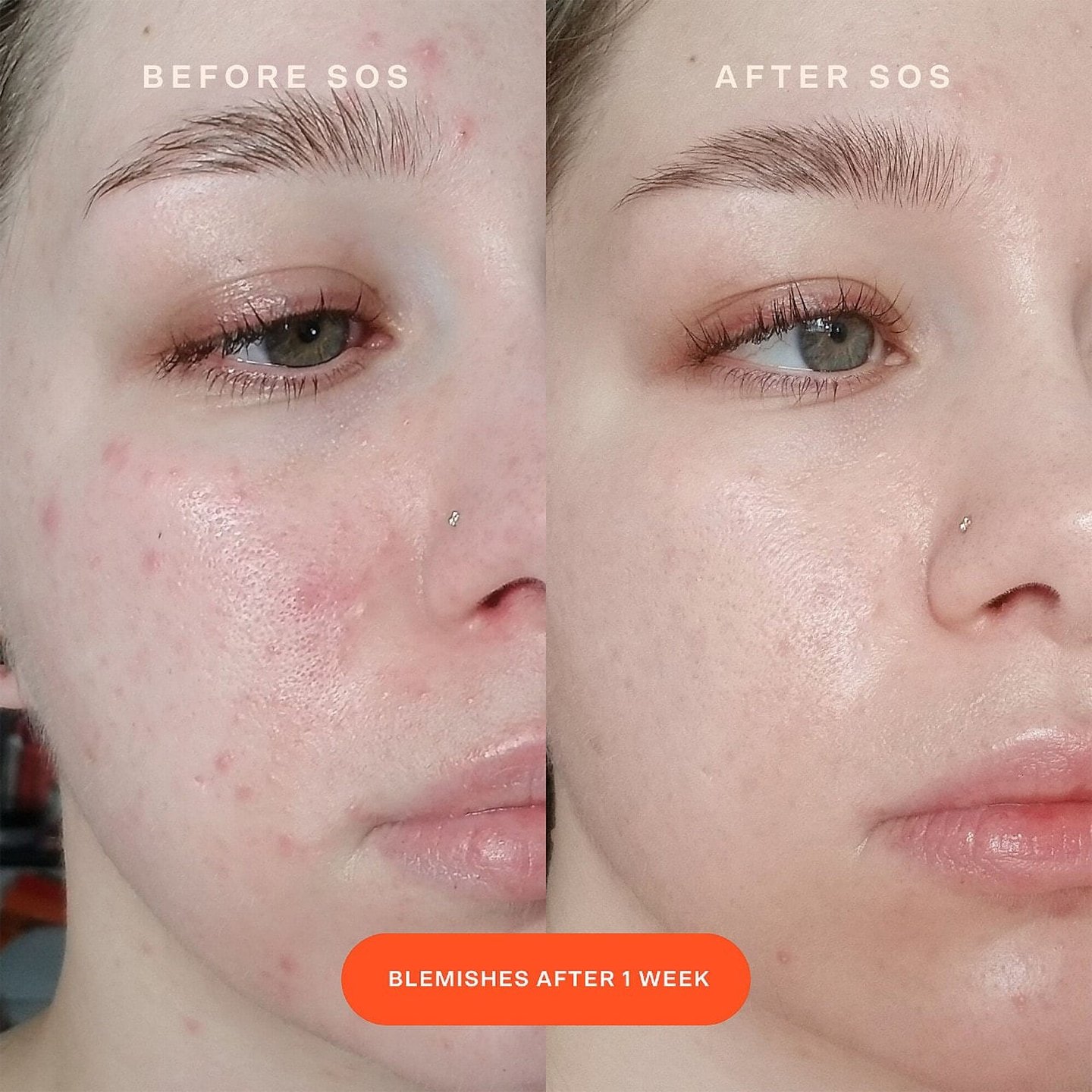 Why Hypochlorous Serum is Your Skin’s New Best Friend