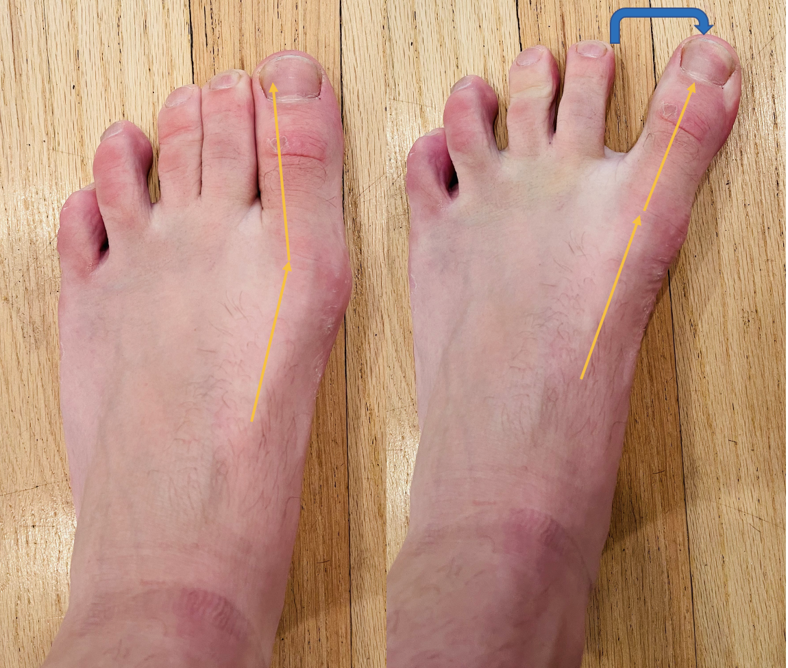 Hallucis Muscle Pain? Causes, Symptoms & Quick Relief Tips