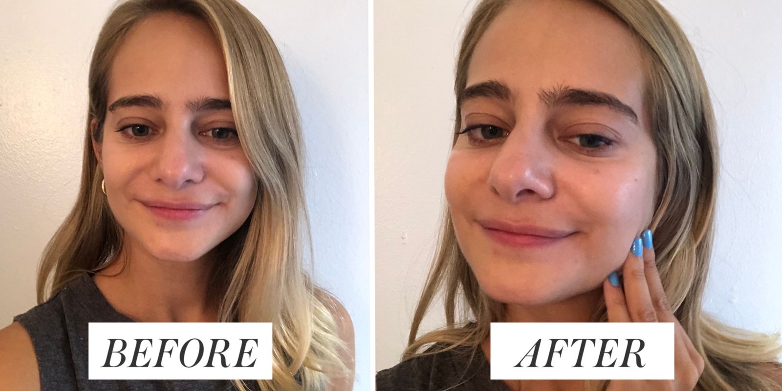 Hyaluronic Acid Serum Before After Results You Need to See