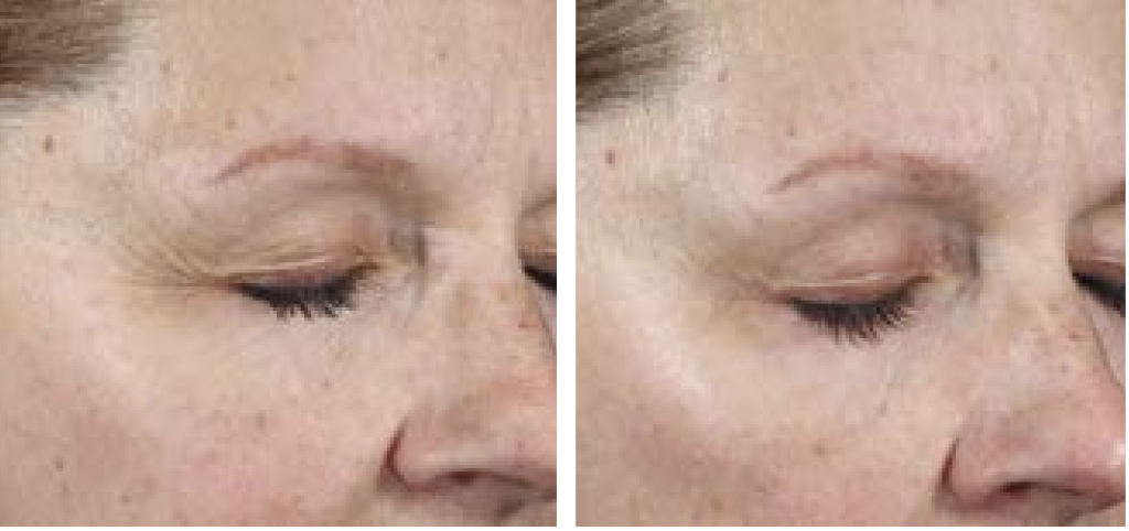 Plated Intense Serum: 6-Week Wrinkle Transformation