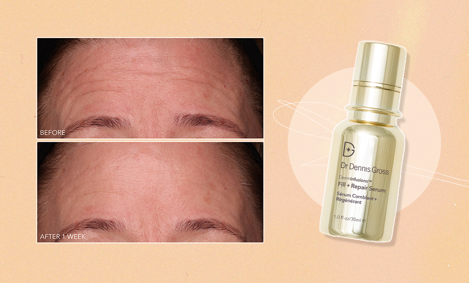 Dennis Gross Fill and Repair Serum vs Botox: Which Wins?