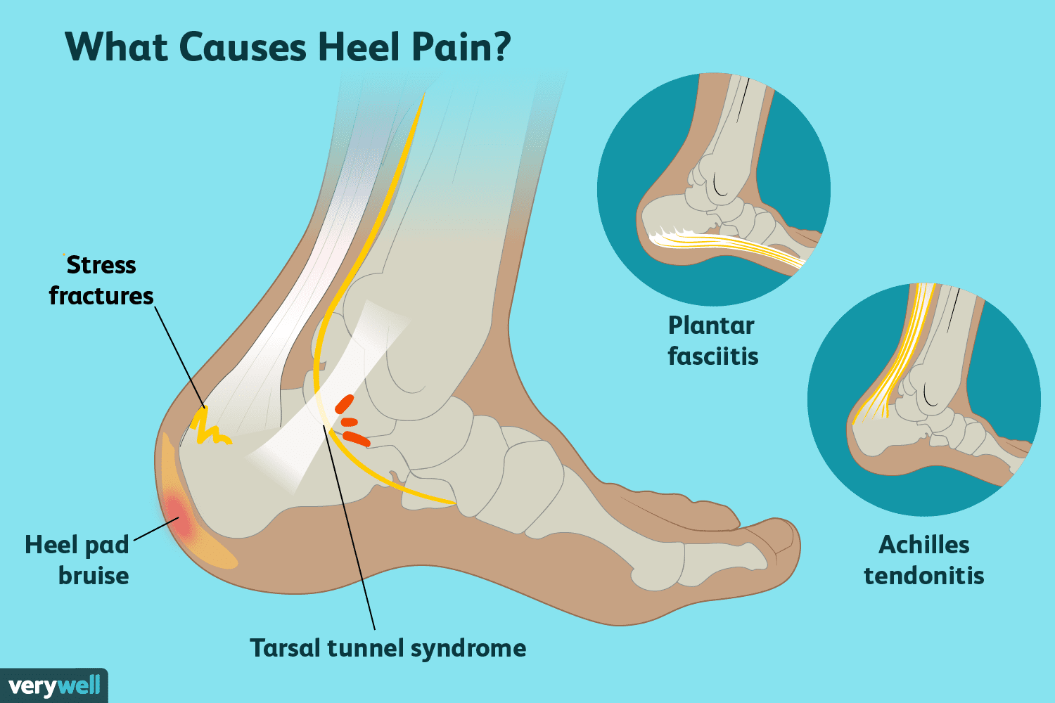 Stiff Feet in Morning? Causes of Heel Pain & Achilles Tendinitis Explained