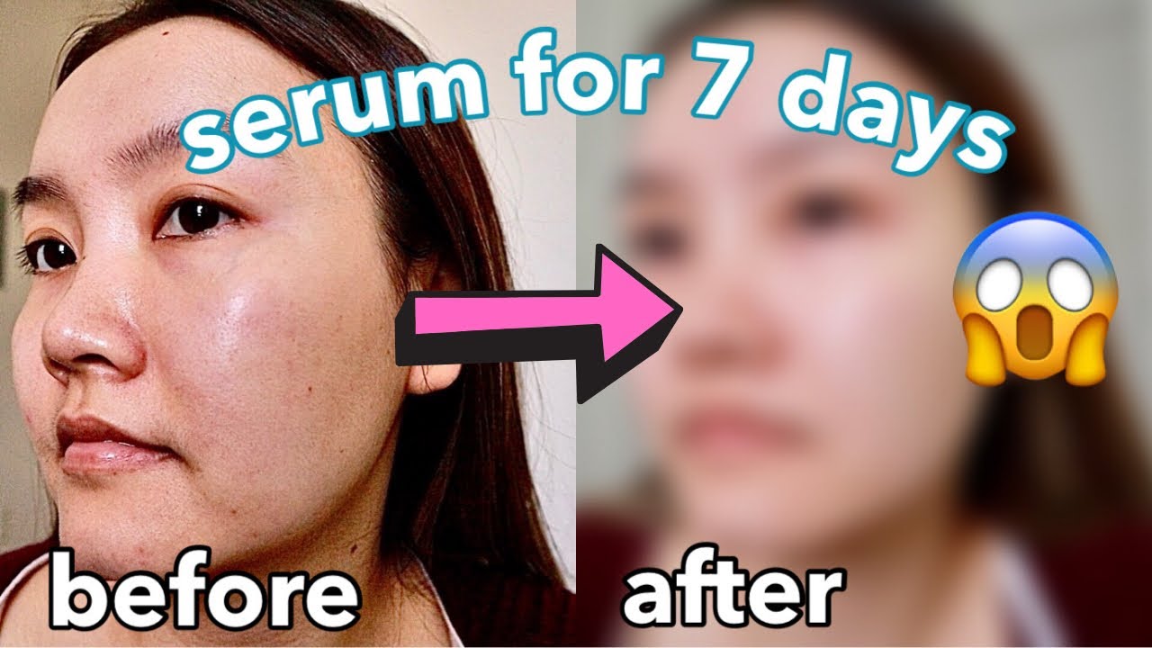 Hyaluronic Acid Serum Before After Results You Need to See