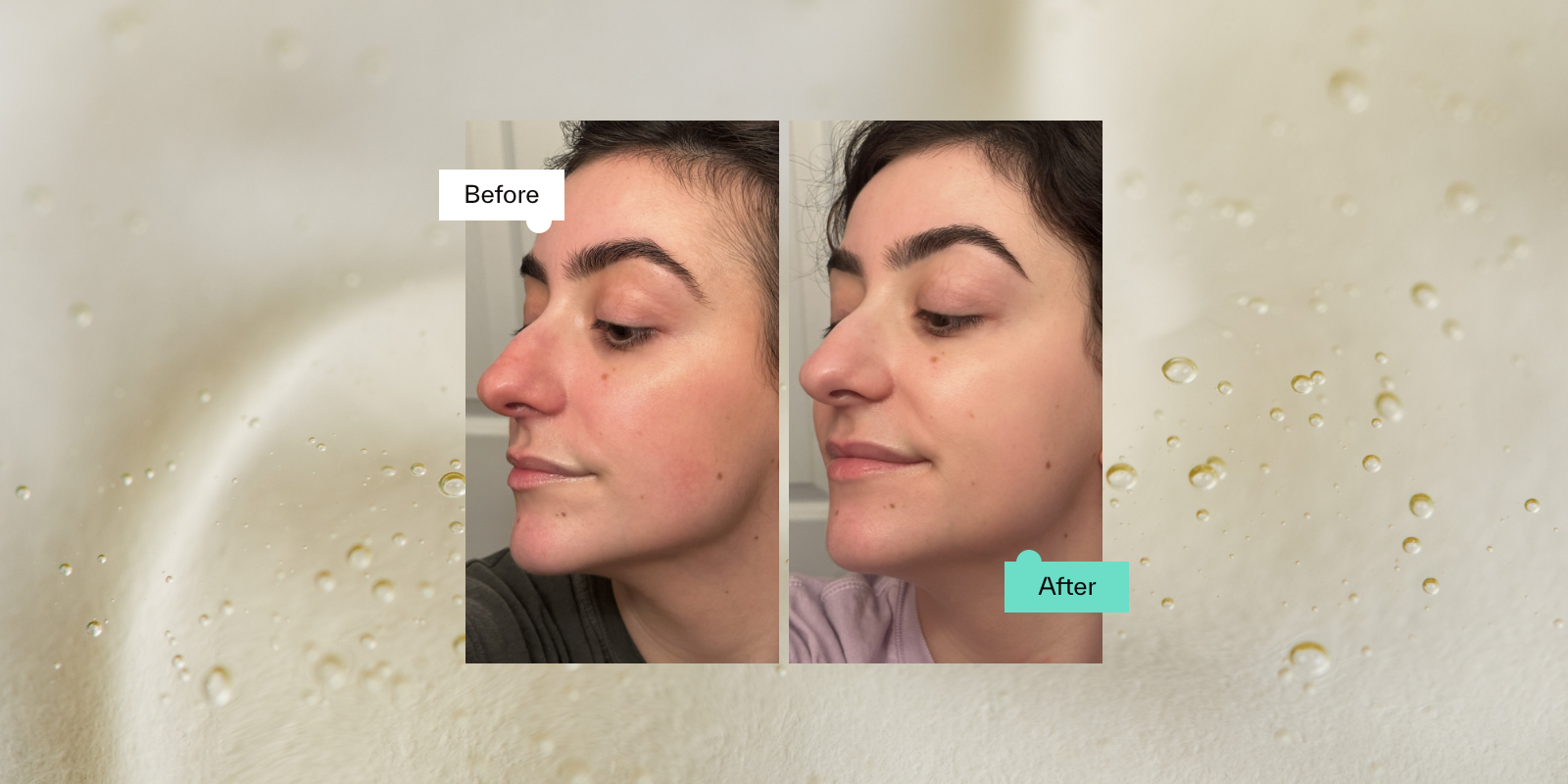 Hyaluronic Acid Serum Before After Results You Need to See