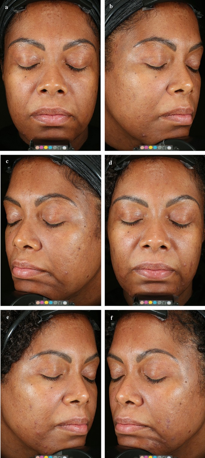 Hyaluronic Acid Serum Before After Results You Need to See