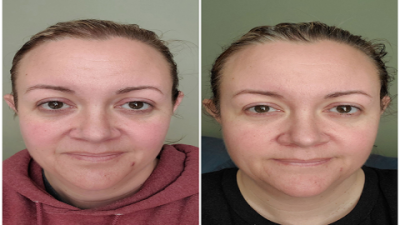 Youthology Serum Before & After: Shocking Results