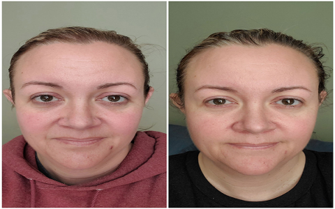 Youthology Serum Before & After: Shocking Results