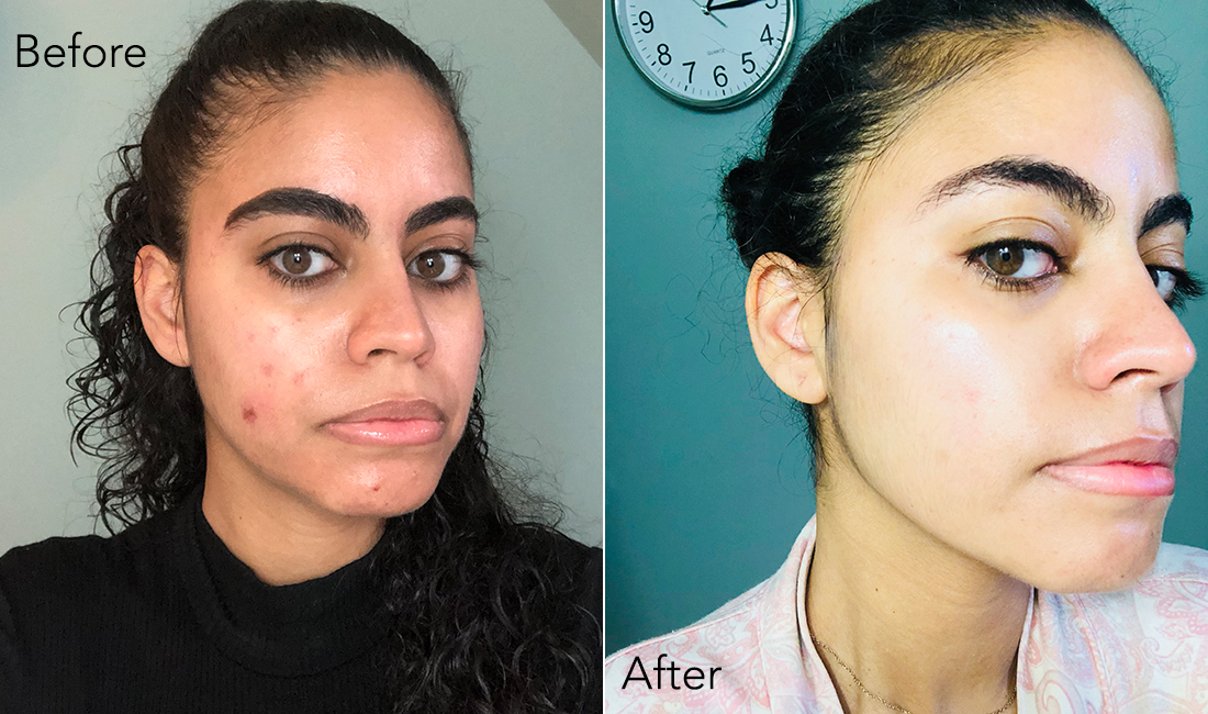 Dark Spots Fade: Vitamin C Serum Before and After Glow