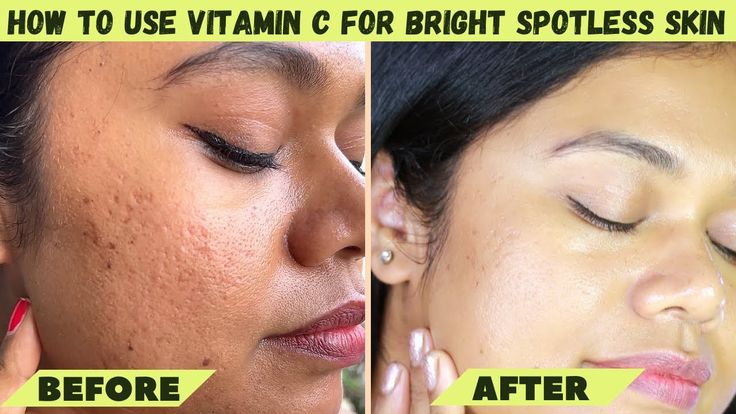 Dark Spots Fade: Vitamin C Serum Before and After Glow