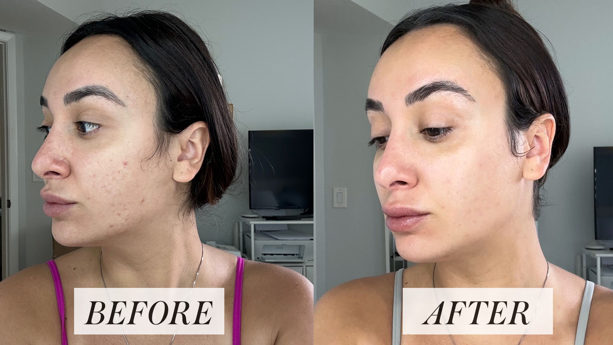 Best Aestura Serum for Acne: Before & After Results