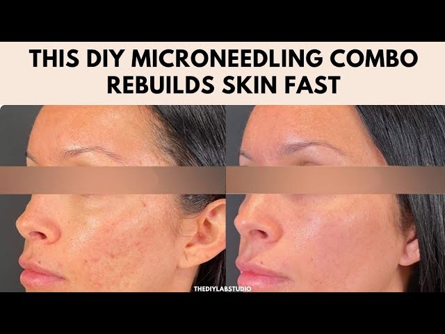 Best Microneedling with Serum: Get Glowing Skin Fast!