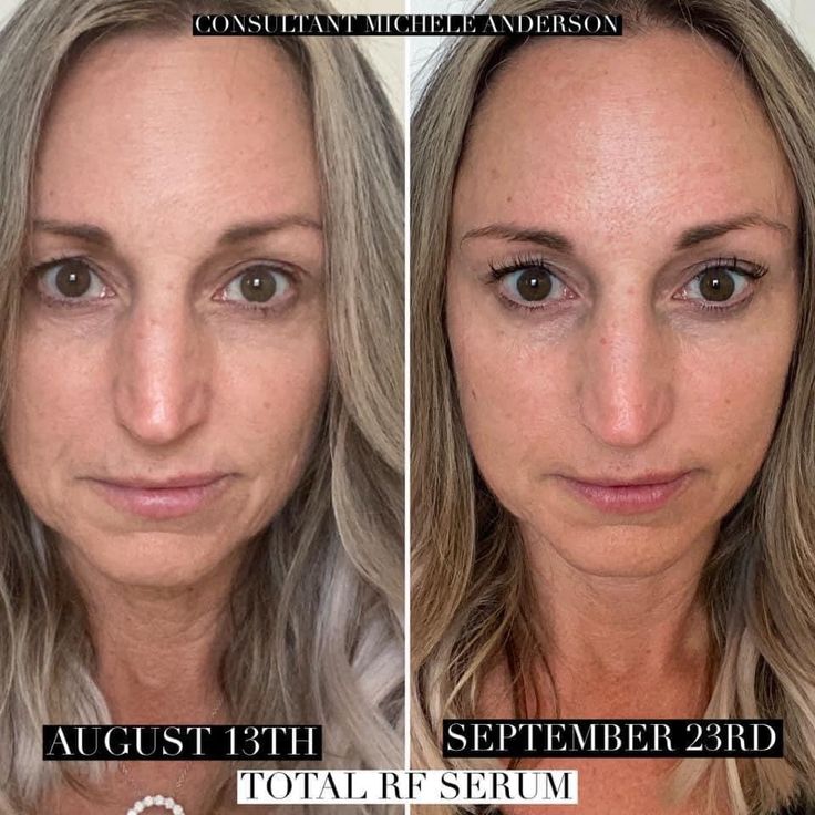 Youthology Serum Before & After: Shocking Results