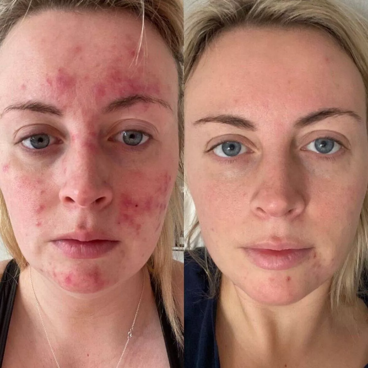47 Skin Serum Kills 99.9% Acne Bacteria - See How